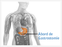 gastrostomie